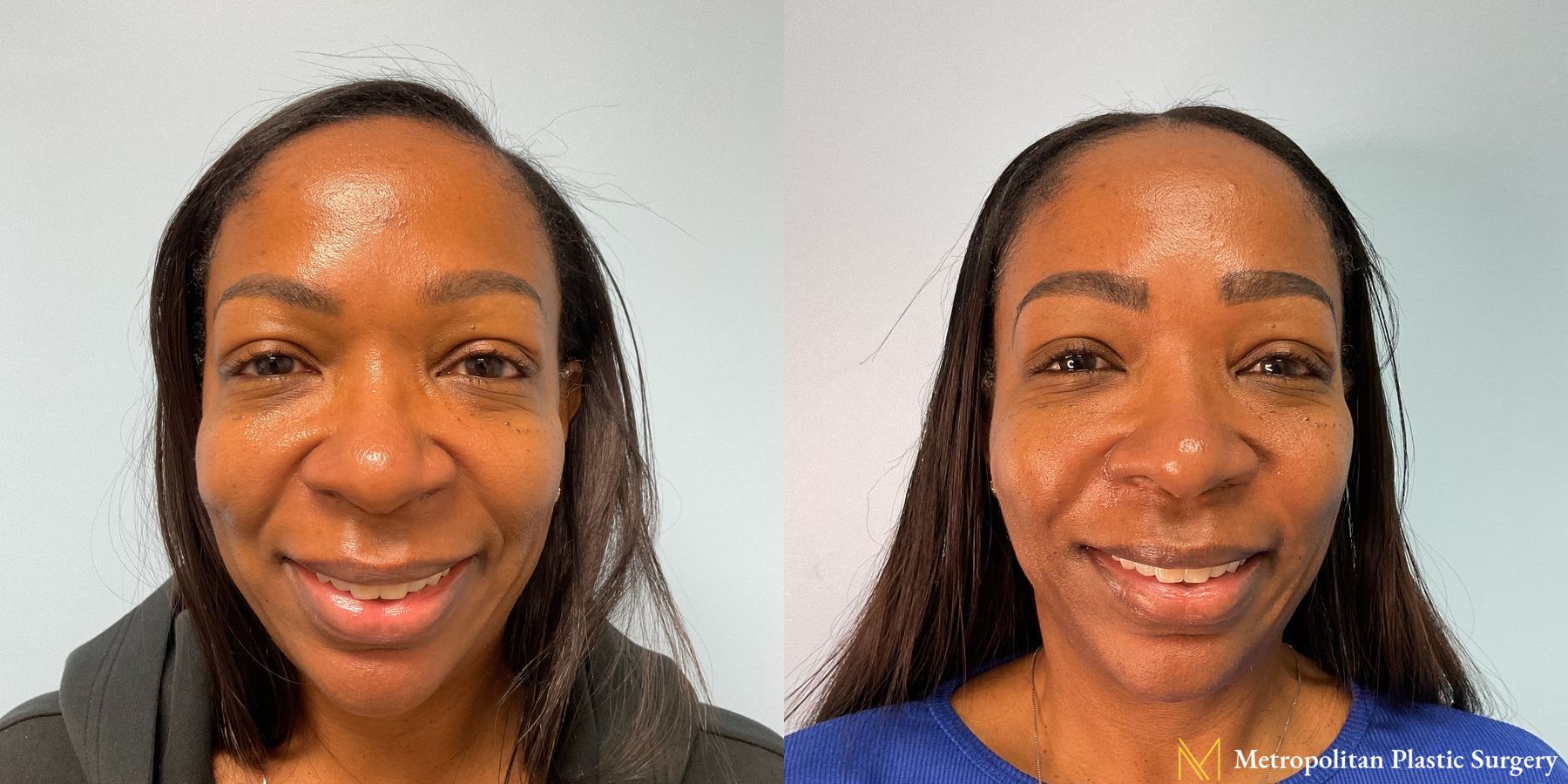 Before and after Fillers case 12363