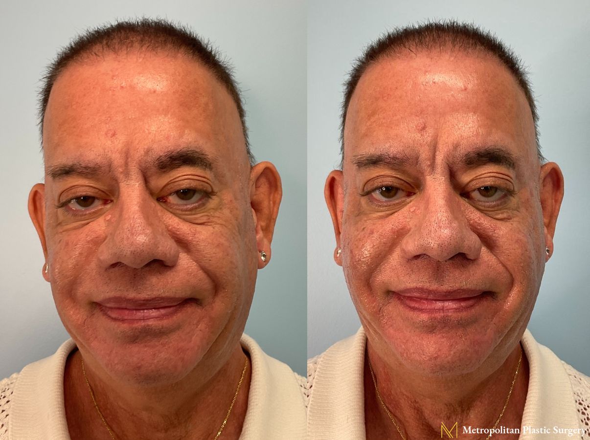 Radiesse Filler in Cheeks performed by Dr. Julia Spears at Metropolitan Plastic Surgery in Marlton, NJ - Angle 2