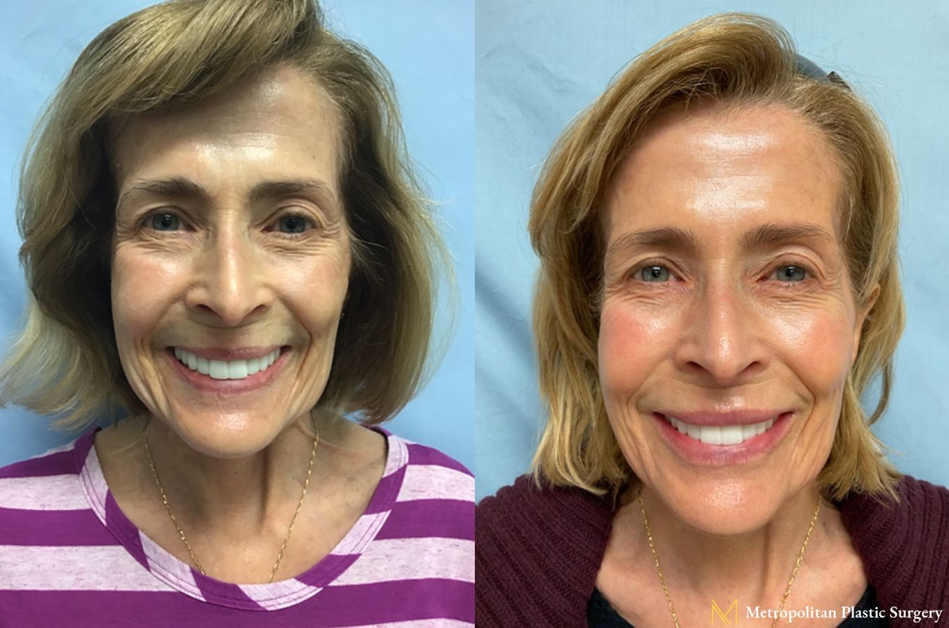 Before and after BOTOX® Cosmetic case 10053