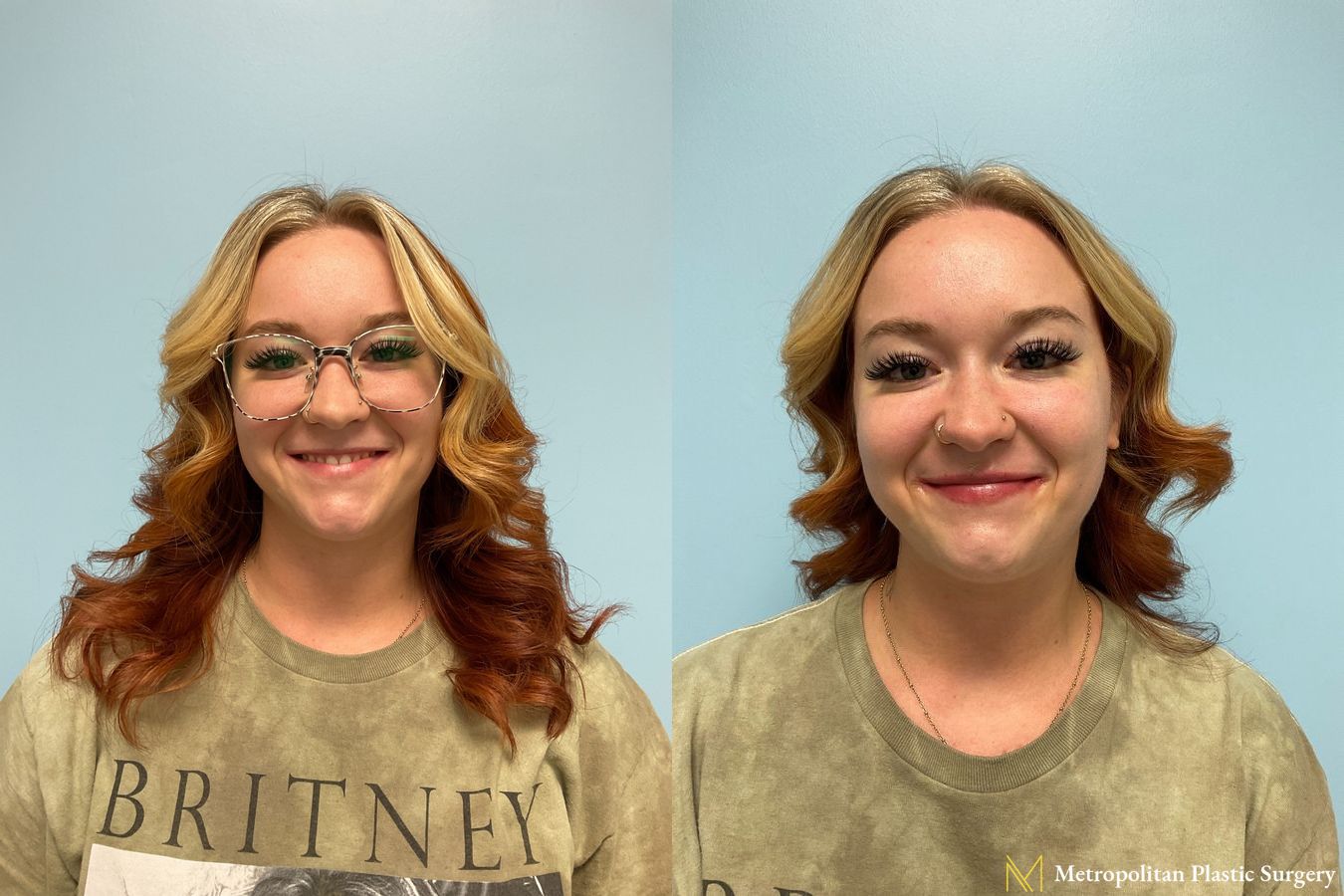 Radiesse dermal filler to erase wrinkles and folds for immediate and long lasting results. - Angle 2