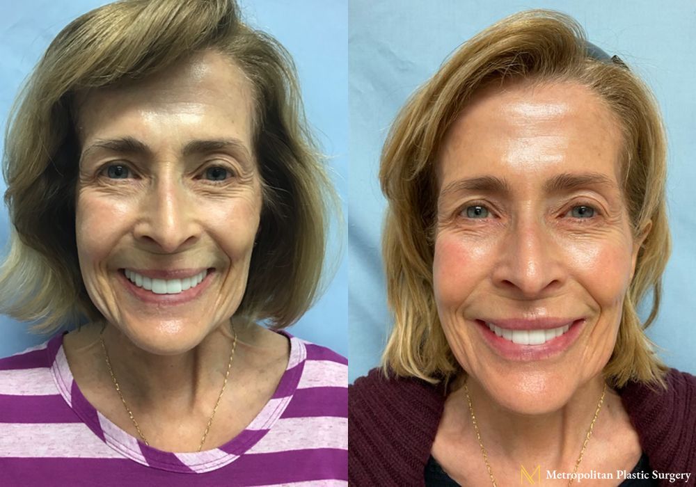 Before and after BOTOX® Cosmetic case 10053