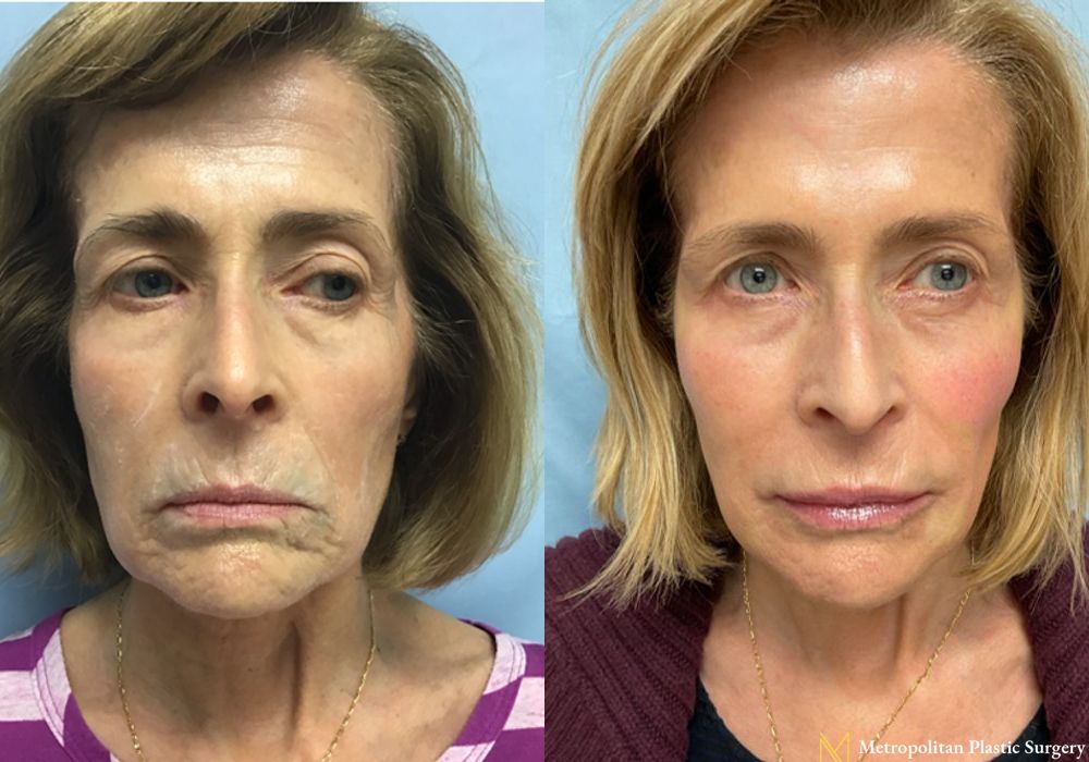 BOTOX® Cosmetic - Thumbnail 2