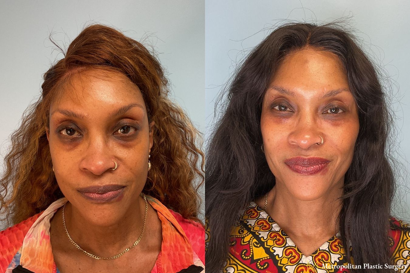 Before and after Fillers case 41735