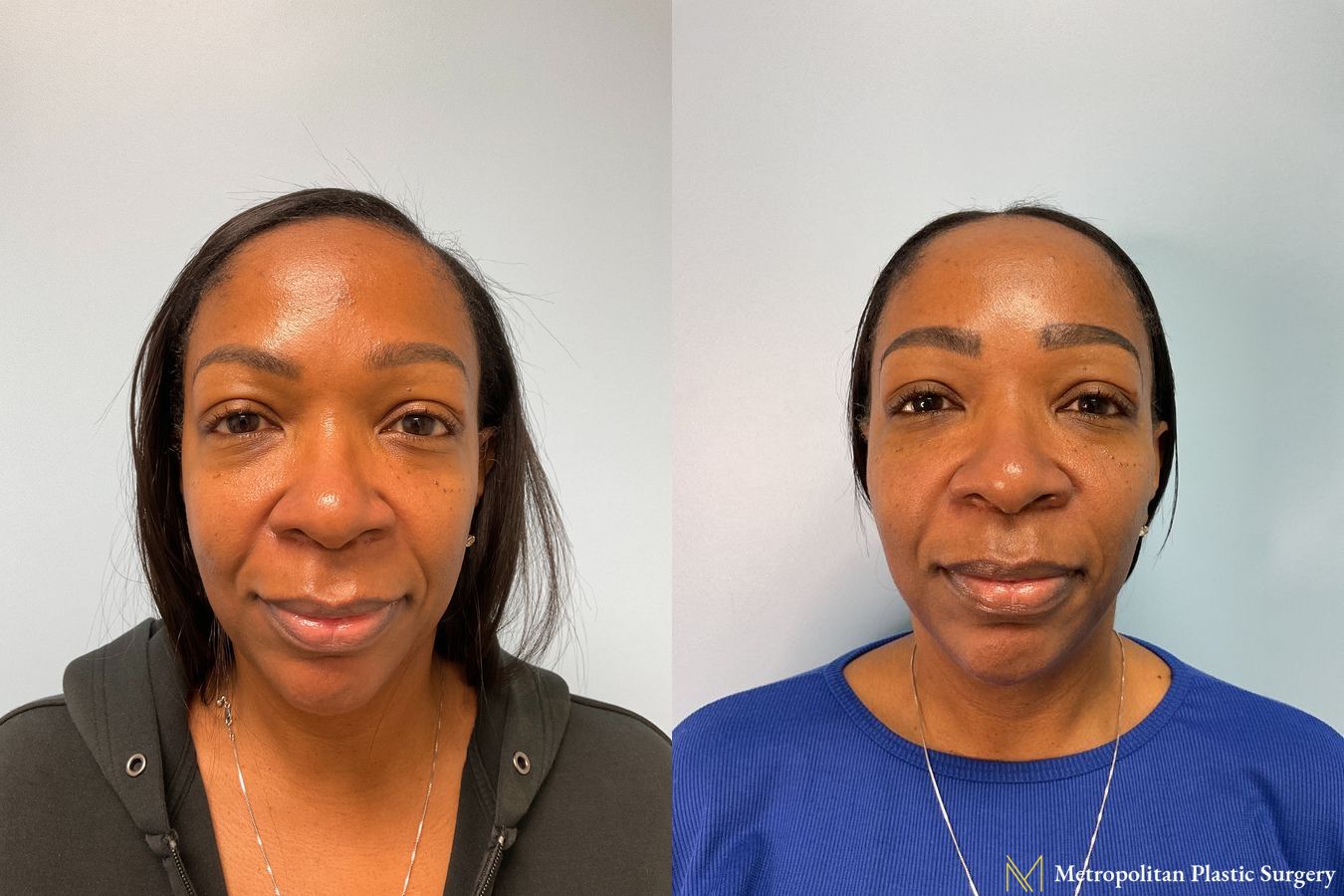 Before and after Fillers case 12363 - Angle 2