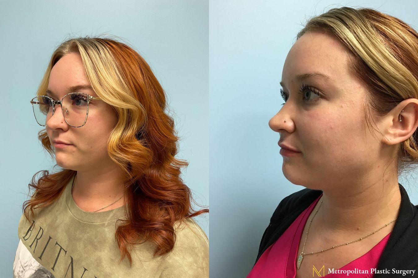 Radiesse dermal filler to erase wrinkles and folds for immediate and long lasting results. - Angle 4