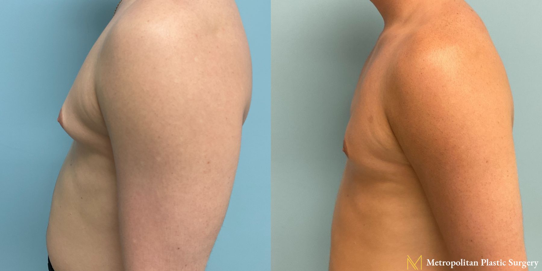 Before and after Gynecomastia case 8062 - Angle 5