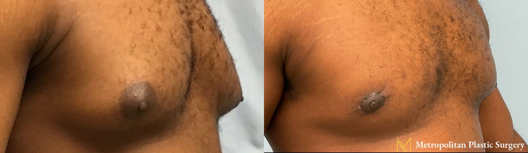 Gynecomastia treatment from Julia Spears MD to reduce male breast size. - Angle 2