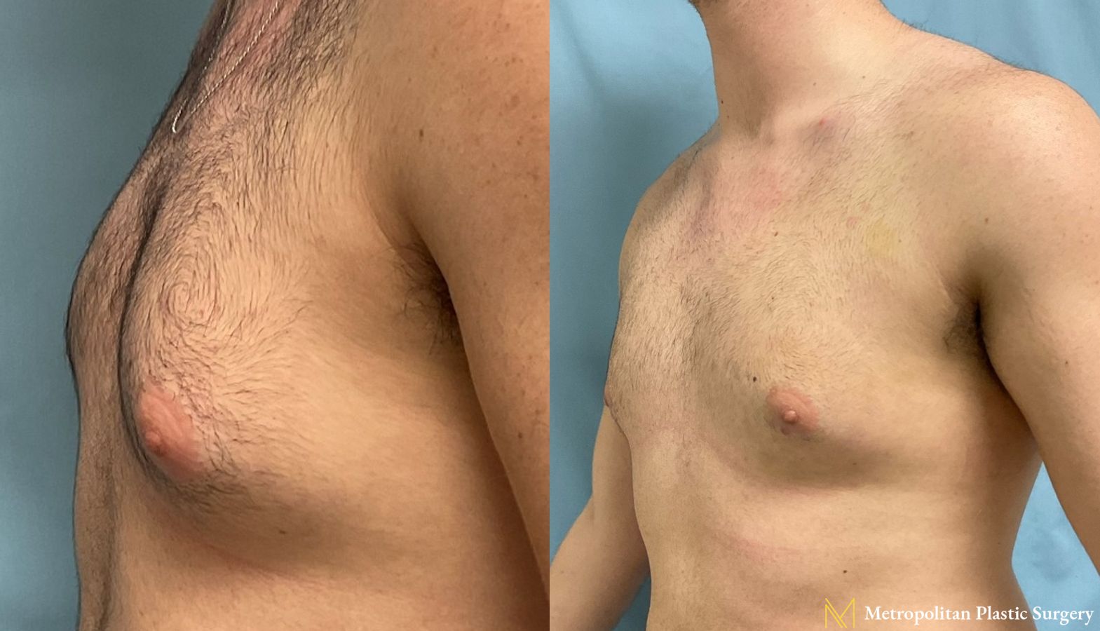 Gynecomastia treatment from Julia Spears MD to reduce male breast size. - Angle 3