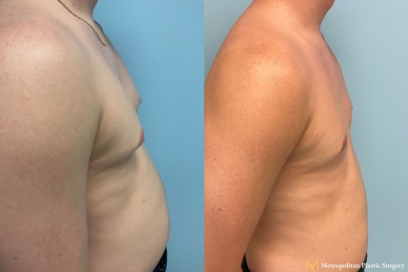 Before and after Gynecomastia case 8062 - Angle 2