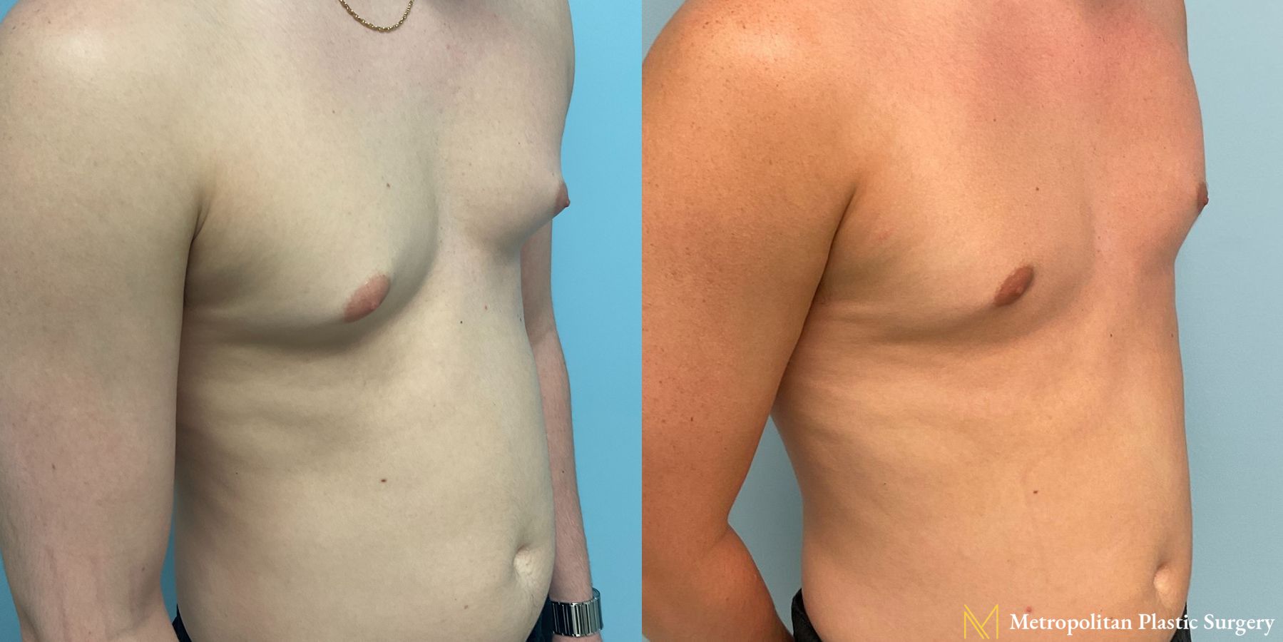 Before and after Gynecomastia case 8062 - Angle 3