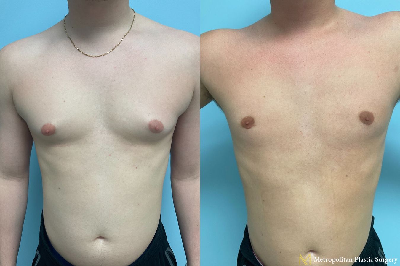 Before and after Gynecomastia case 8062