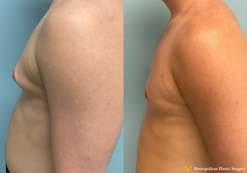 Before and after Gynecomastia case 8062 - Angle 5