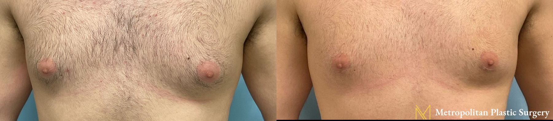 Gynecomastia treatment from Julia Spears MD to reduce male breast size.