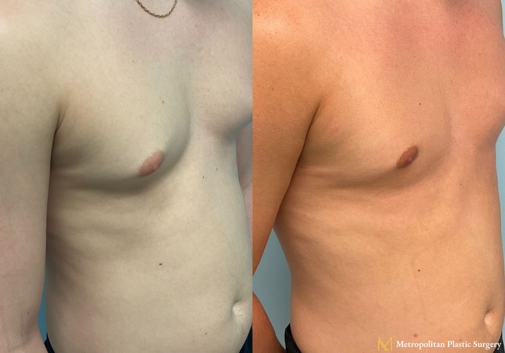 Before and after Gynecomastia case 8062 - Angle 3