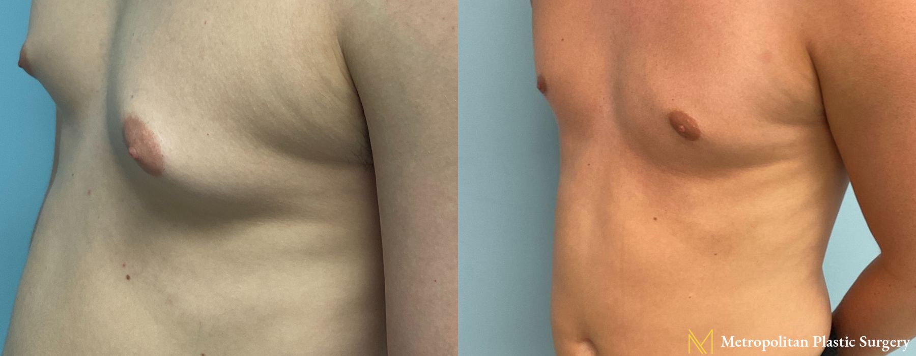 Before and after Gynecomastia case 8062 - Angle 4