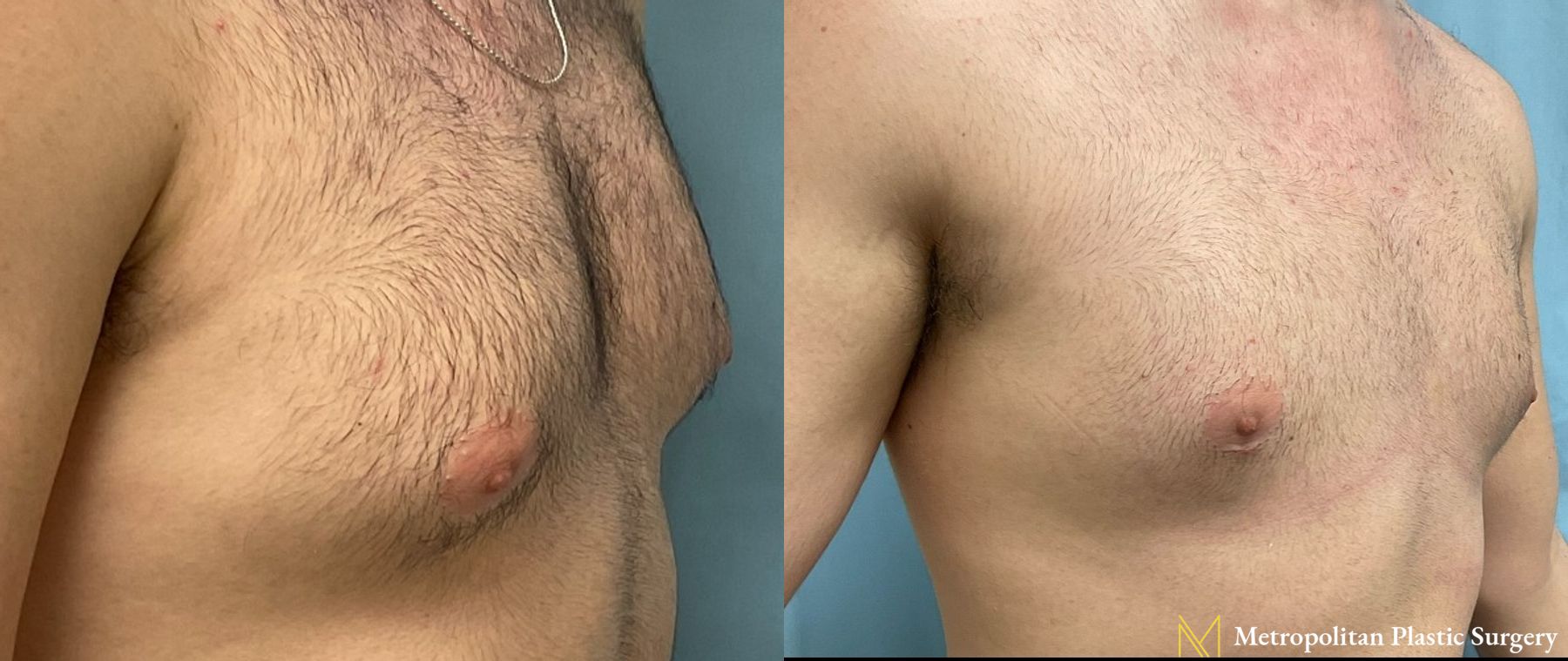 Gynecomastia treatment from Julia Spears MD to reduce male breast size. - Angle 2