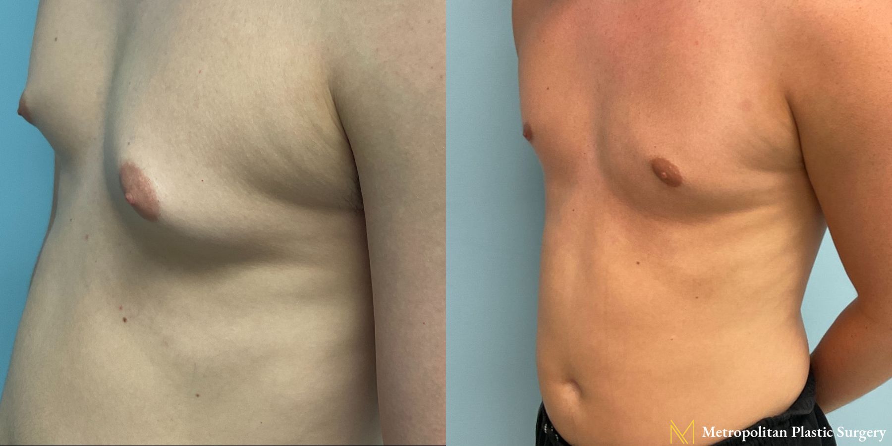 Before and after Gynecomastia case 8062 - Angle 4