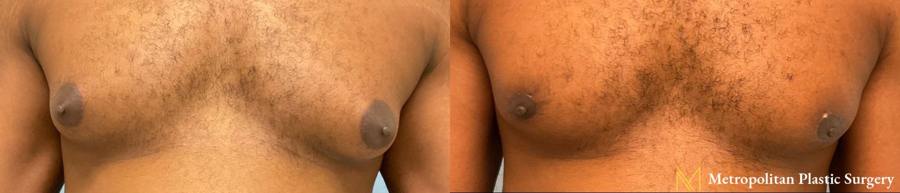 Gynecomastia treatment from Julia Spears MD to reduce male breast size.