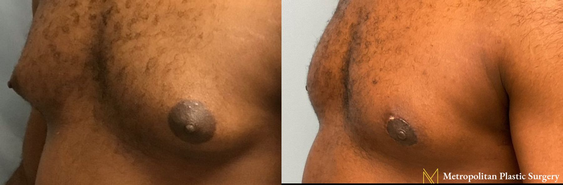 Gynecomastia treatment from Julia Spears MD to reduce male breast size. - Angle 3