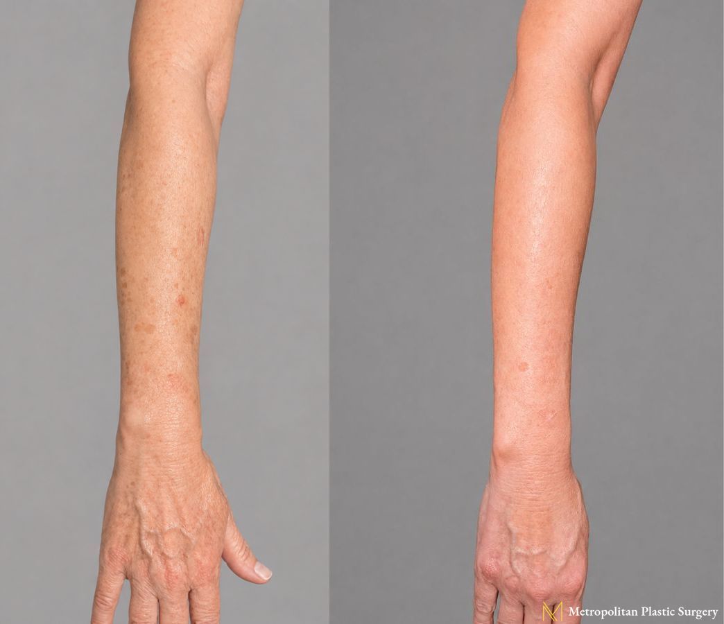 IPL Treatment for Arms for Aging and Sun Spots performed at Metropolitan Plastic Surgery at the office of Dr. Julia Spears