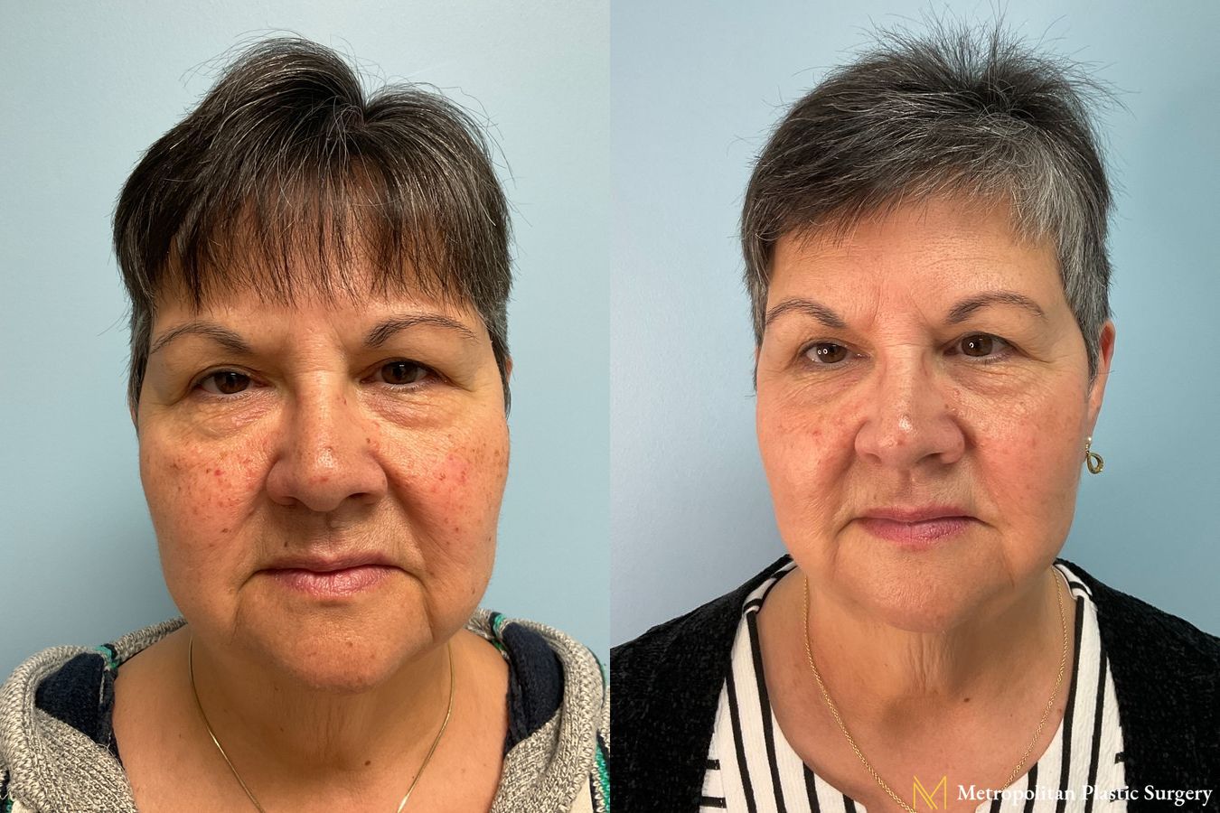 Before and after Hydrafacials case 16109