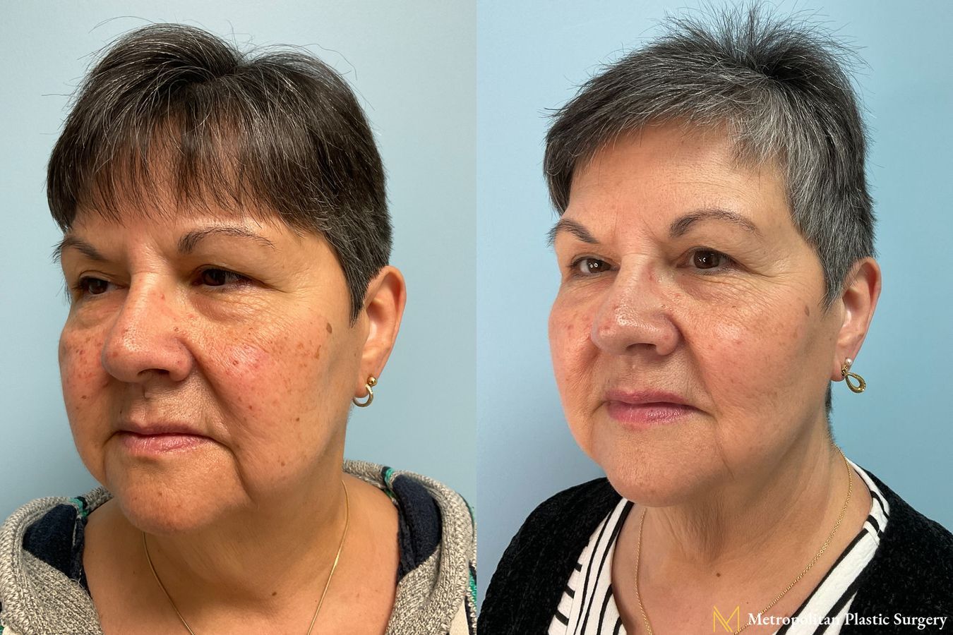 Before and after Hydrafacials case 16109 - Angle 2