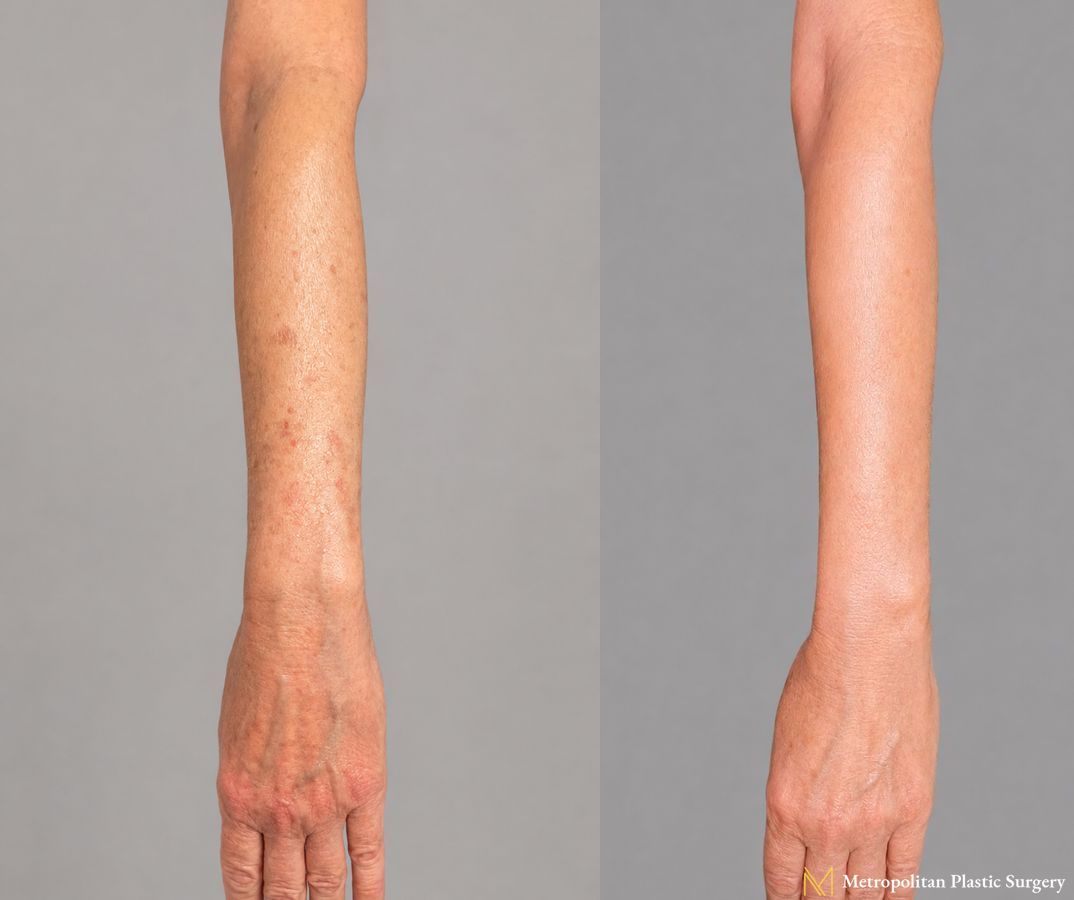 IPL Treatment for Arms for Aging and Sun Spots performed at Metropolitan Plastic Surgery at the office of Dr. Julia Spears - Angle 2