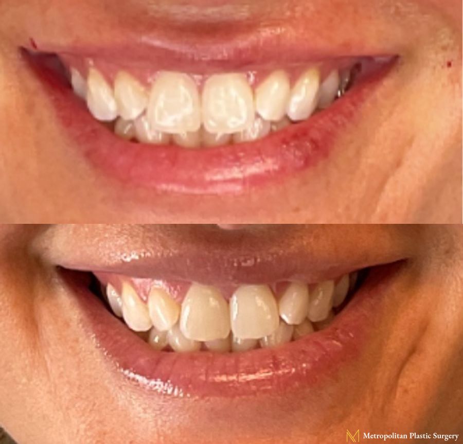 Obagi Magiq Lip Filler in Upper Lip performed by Dr. Julia Spears at Metropolitan Plastic Surgery - Angle 2