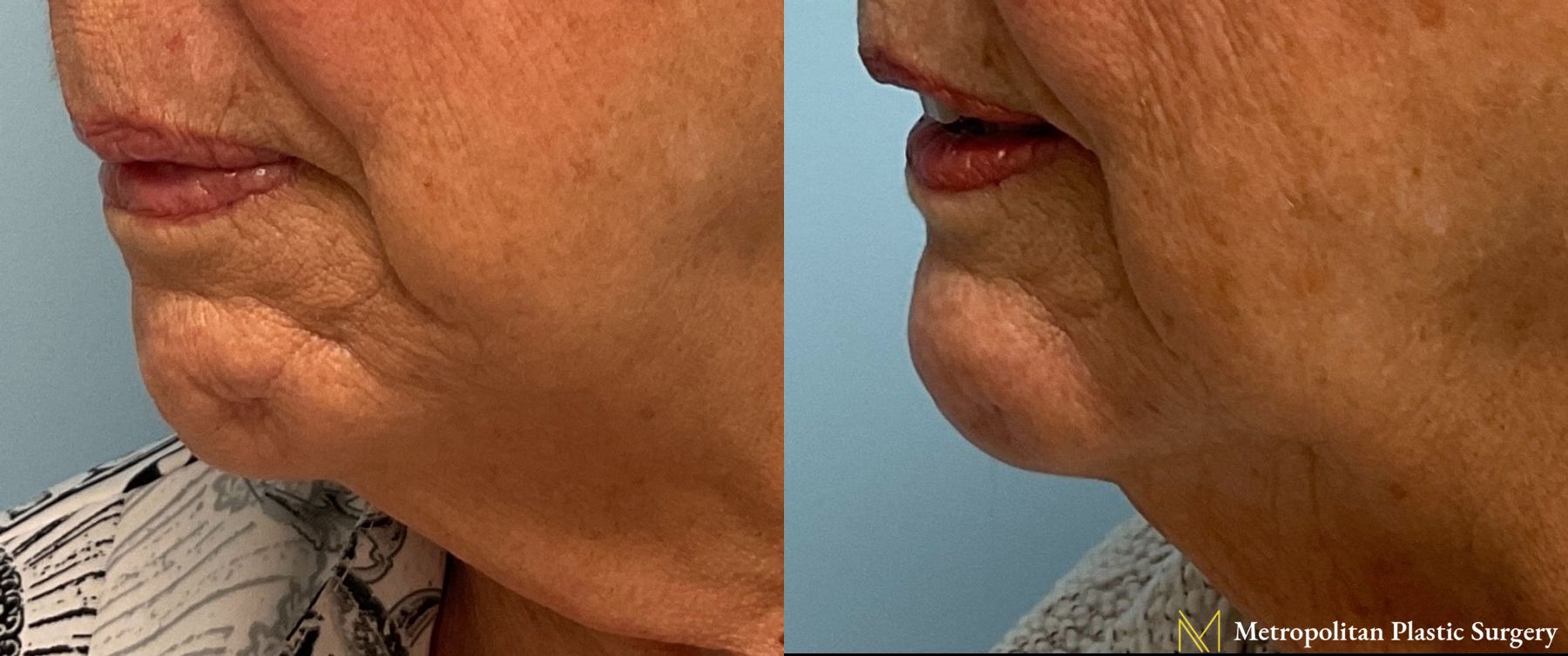 Radiesse Dermal Filler Before and After Smooth Skin Without Lines or Wrinkles - Angle 4