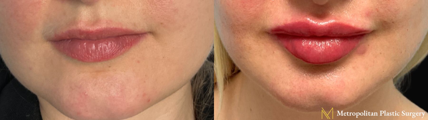 Before and after Lip Filler case 21701