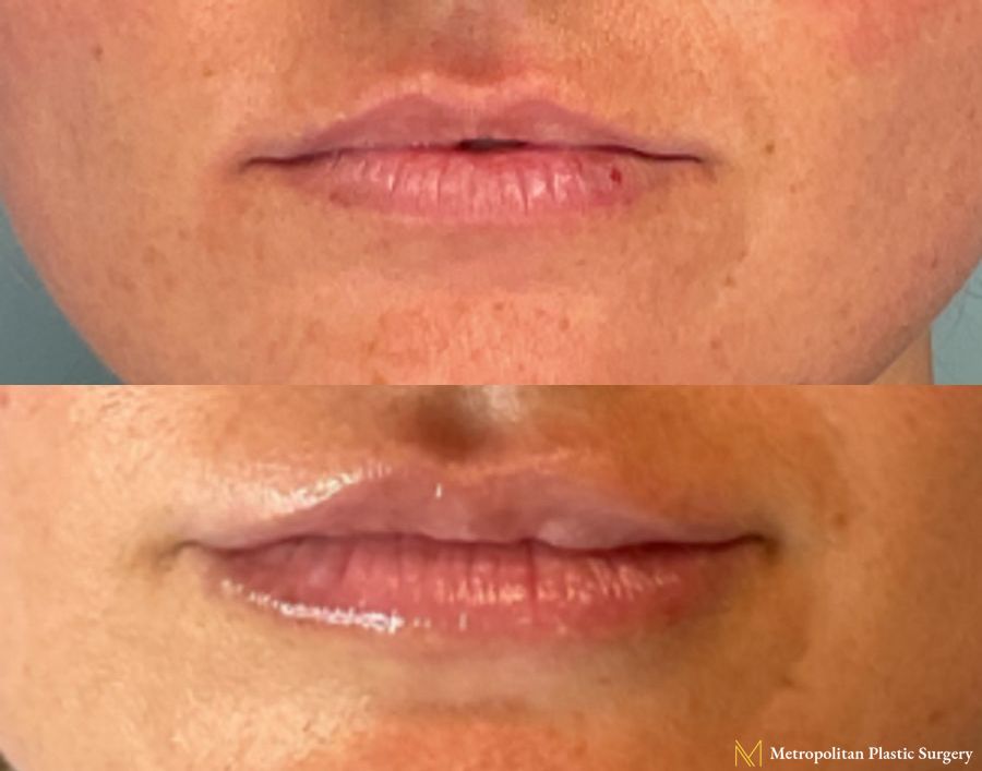 Obagi Magiq Lip Filler in Upper Lip performed by Dr. Julia Spears at Metropolitan Plastic Surgery