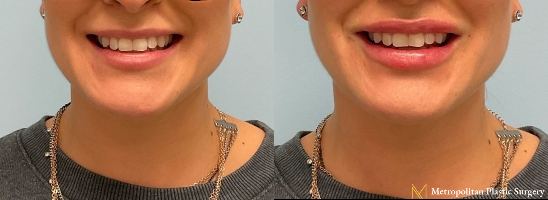 Radiesse dermal filler to erase wrinkles and folds for immediate and long lasting results. - Angle 2