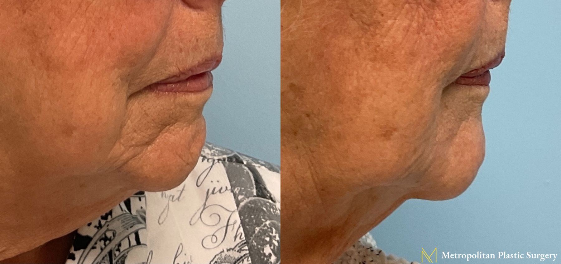 Radiesse Dermal Filler Before and After Smooth Skin Without Lines or Wrinkles - Angle 2