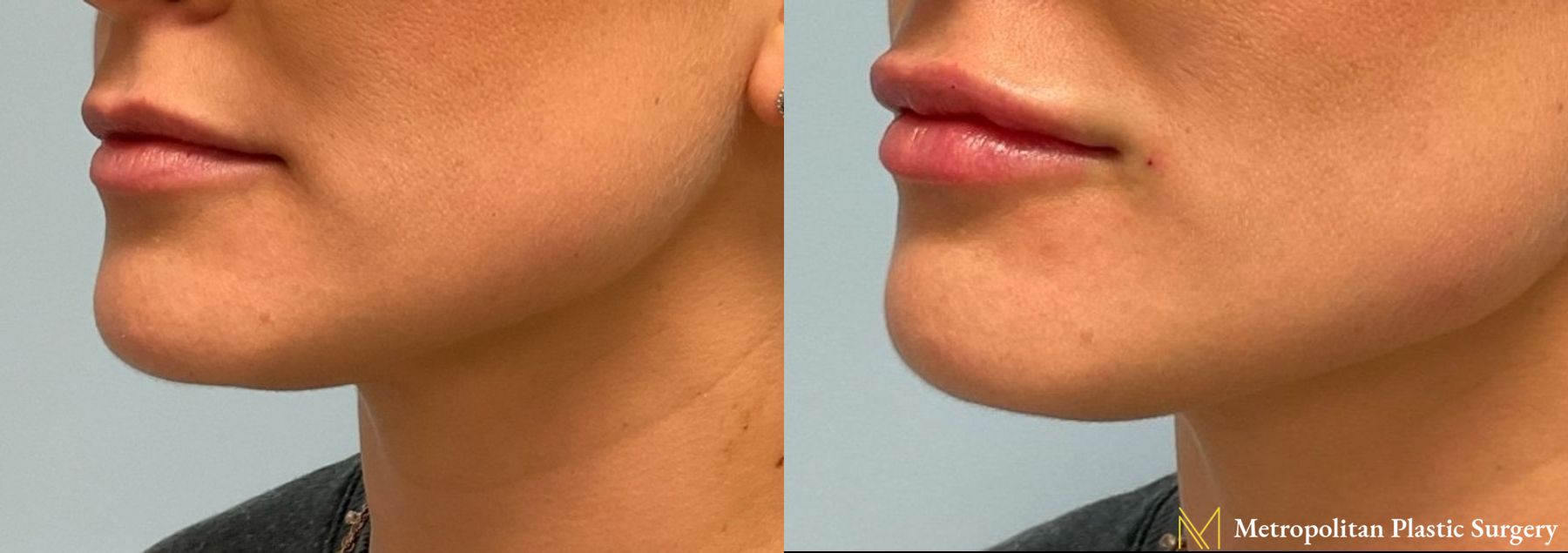 Radiesse dermal filler to erase wrinkles and folds for immediate and long lasting results. - Angle 4