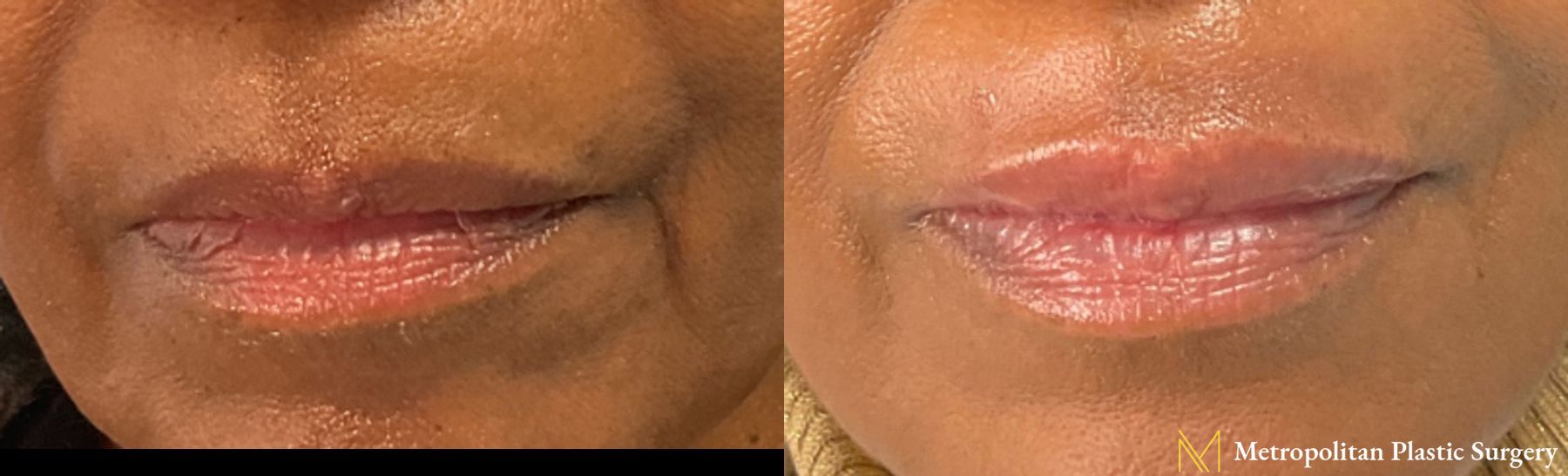 Versa Filler to Upper Lip performed by Dr. Julia Spears at Metropolitan Plastic Surgery in Marlton, NJ