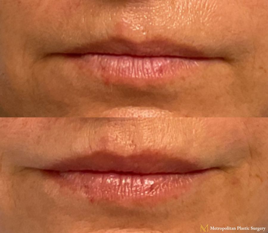 Lip Filler performed by Dr. Julia Spears at Metropolitan Plastic Surgery.