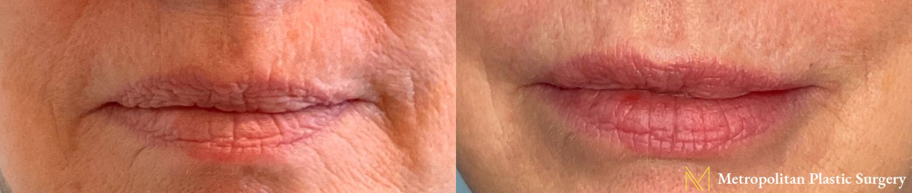 Before and after Lip Filler case 8101