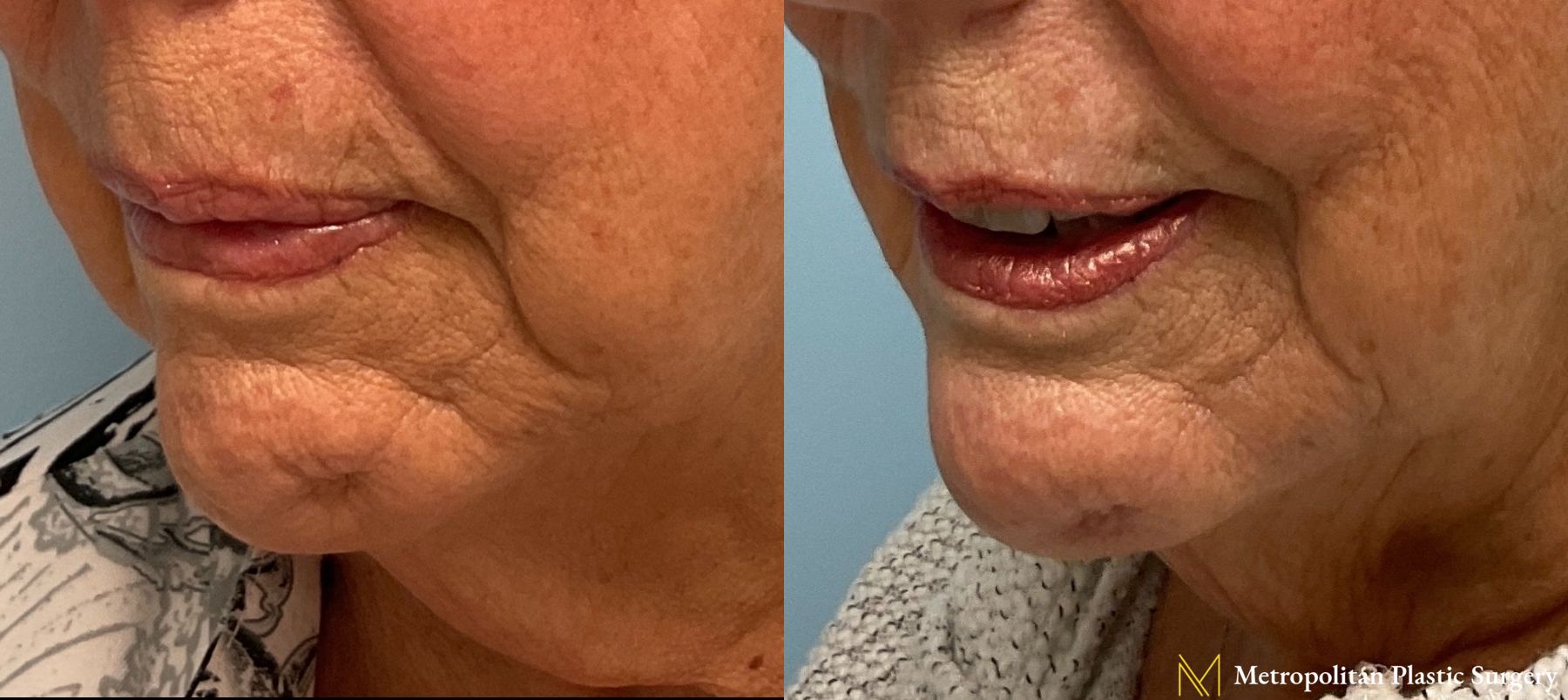 Radiesse Dermal Filler Before and After Smooth Skin Without Lines or Wrinkles - Angle 5