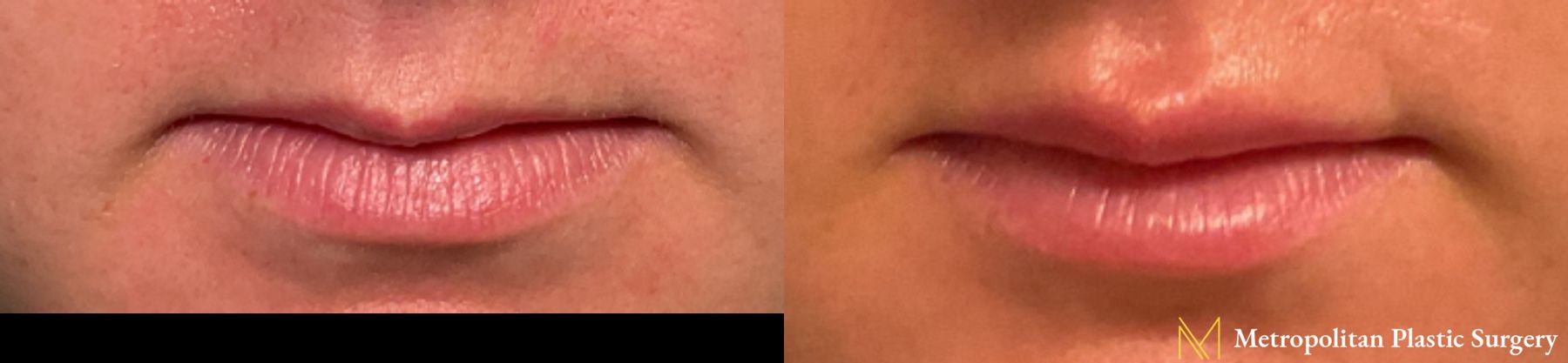 Lip Filler performed by Dr. Julia Spears