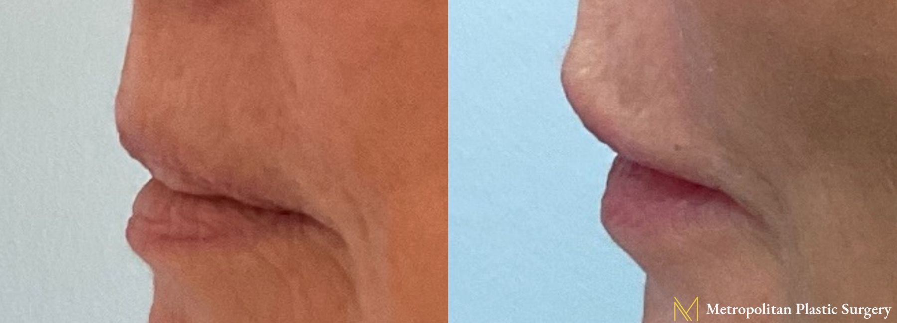 Before and after Lip Filler case 8101 - Angle 3