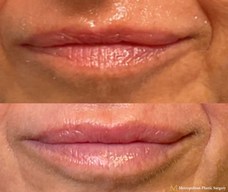 Lip Filler performed by Dr. Julia Spears at Metropolitan Plastic Surgery in Marlton, NJ