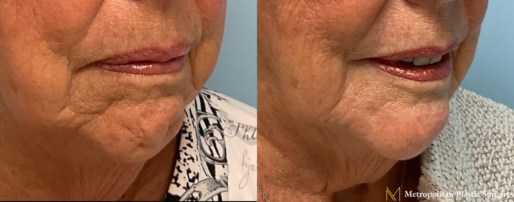 Radiesse Dermal Filler Before and After Smooth Skin Without Lines or Wrinkles - Angle 3
