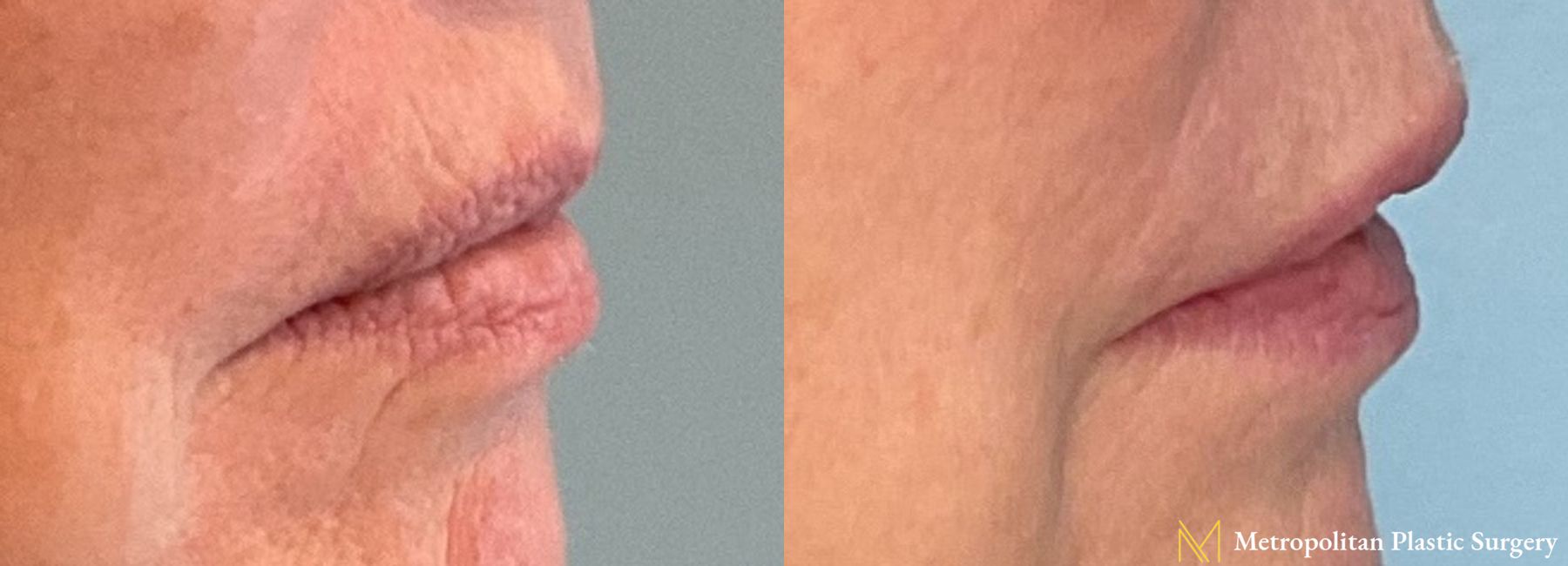 Before and after Lip Filler case 8101 - Angle 2