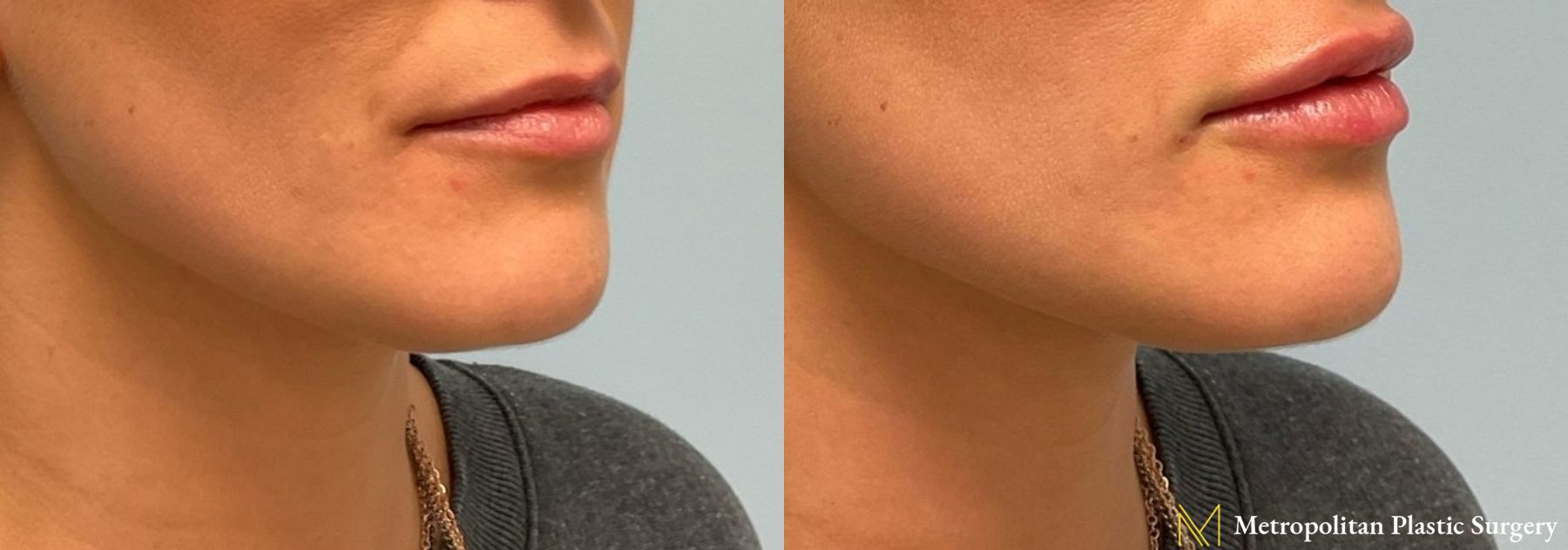Radiesse dermal filler to erase wrinkles and folds for immediate and long lasting results. - Angle 3