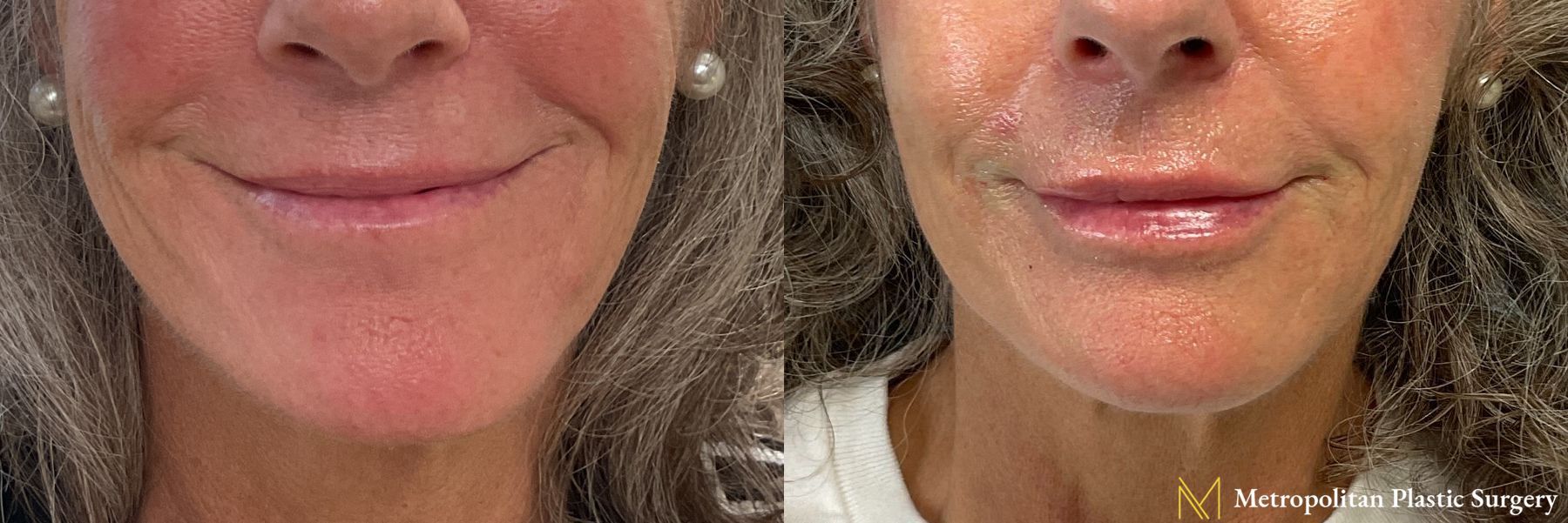 Lip Filler performed by Dr. Julia Spears