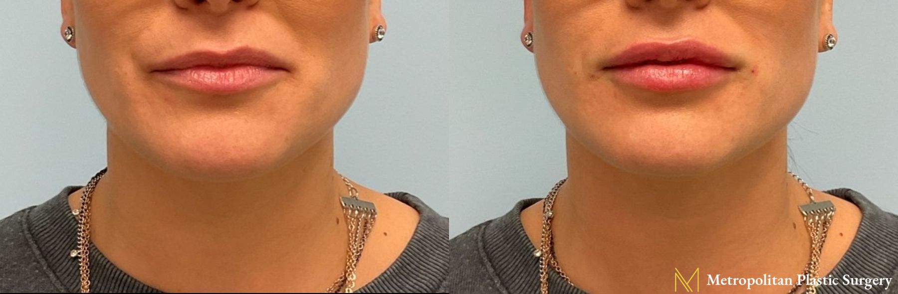 Radiesse dermal filler to erase wrinkles and folds for immediate and long lasting results.
