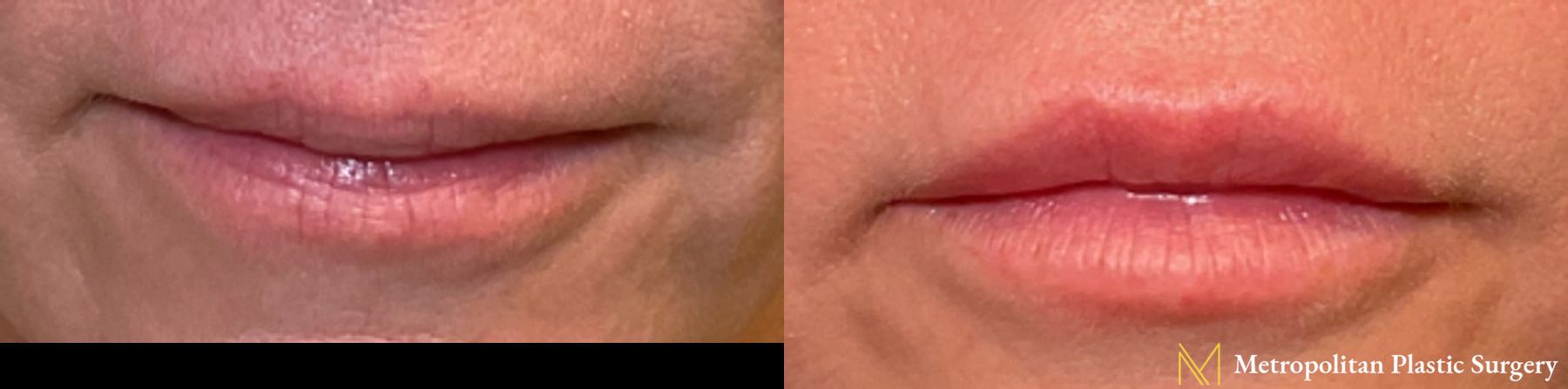 Lip Filler injections performed by Dr. Julia Spears