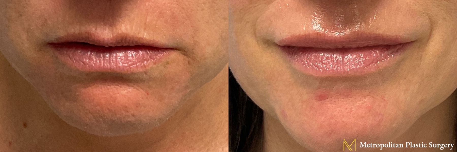 Lip Filler performed by Dr. Julia Spears