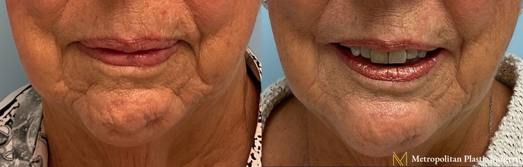 Radiesse Dermal Filler Before and After Smooth Skin Without Lines or Wrinkles