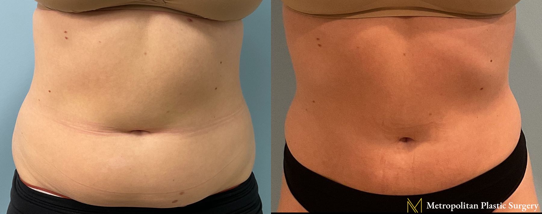 Before and after Liposuction case 23987